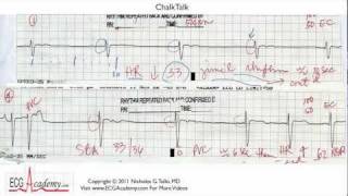 ECG Interpretation Tutorial - ChalkTalk 14 - Advanced Level