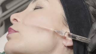 KARISMA |  Soft filler biorestitutivo