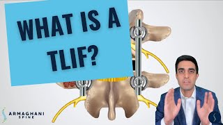 TLIF を実行する方法 (および実行後に期待される結果)