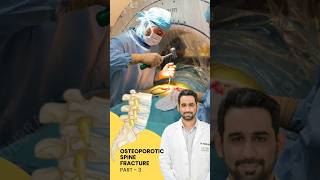 Treatment of Osteoporotic spine fracture || Dr. Dheeraj Batheja || Artemis Hospital  #doctor #spine