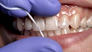Most Satisfying Dental Cleaning | ASMR for Sleep
