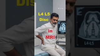 MRI showed L4-L5 disc herniation… but his recovery story will surprise you #backpainrelief