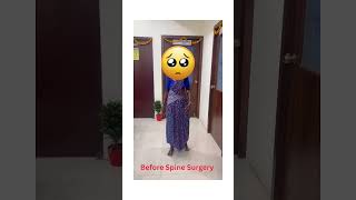 Before  Spine Surgery #spinesurgery #surgery #backpain #spinesurgeon #backpaintreatment
