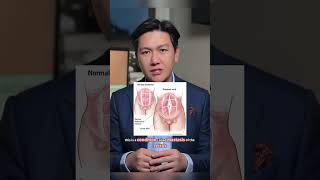 What is Abdominal Muscle Repair