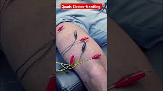 Knee Pain RELIEF with Electroneedling for Quads!