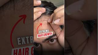 Fix Your Receding Hairline | Hairline Regrow Karo