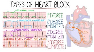 Heart Blocks Made Easy - 1st, 2nd (Mobitz 1/Wenckebach & Mobitz 2), 3rd (Complete) | with ECGs