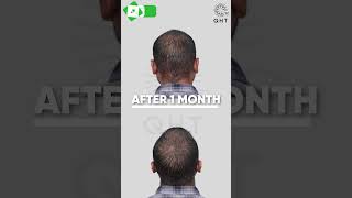 Best Hair Transplant Result | Grade 6 QHT Clinic #shorts #hairtransplant #besthairtransplantinindia
