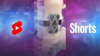 What is Anterior Lumbar Interbody Fusion? | ALIF #Shorts