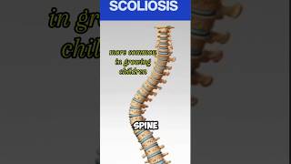NEVER IGNORE scoliosis in childhood! #shorts #scoliosis #deformity #spine #awareness #neglectedcurve