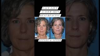 Stunning Before and After of a Deep Face and Neck lift with Laser Skin Resurfacing