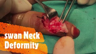 Swan Neck Deformity