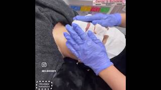 Hydrafacial step by step with Before & after results #hydrafacials  #boldnessby4 #skincareroutine