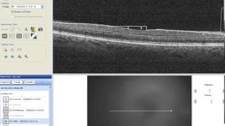 optovue segmentation