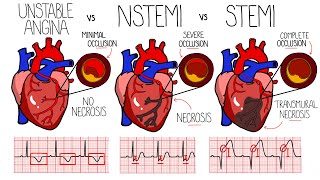 急性冠症候群（心臓発作） - 不安定狭心症 vs NSTEMI vs STEMI | 心電図検査付き