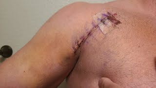 How I rehabbed my pec after surgery - and how to fix shoulder issues