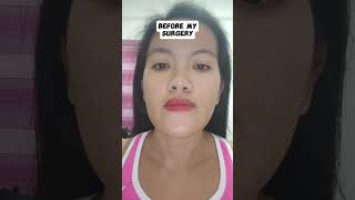 SURGERY #successfulsurgery