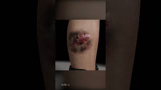 毒蛇に噛まれた場合：治療せずに放置するとどうなるか