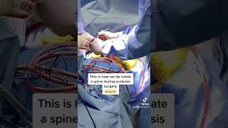 75 度の脊柱側弯症の曲線を矯正します。