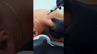 SHOULDER & UPPER BACK PAIN RELIEF with Electroneedling?