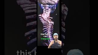 NEVER IGNORE Scoliosis (deformity) of early age! #spine #spineexpert #deformity #shorts #Scoliosis