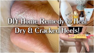 How I Healed my Cracked Heels Using Saran Wrap | DIY Home Remedy for Dry & Cracked Heels