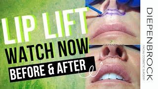 Long/Thin upper lip? Solution: a lip lift. Watch Dr. Diepenbrock and catch a peek at her result!