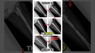 How does LIMB LENGTHENING work?  #limblengtheningsurgery