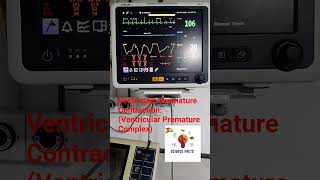 Ventricular Premature Contraction (VPC) | ECG में VPC क्या है? Causes, Symptoms & Treatment in Hindi