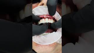 Dental Implants: See the Shocking Before & After Transformation!