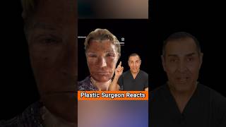 フェノールピールの説明✨