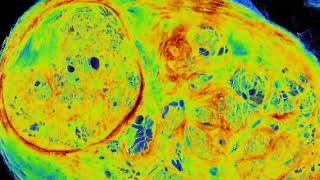 Prostate Cancer visualization by HiP-CT (Hierarchical phase-contrast tomography)